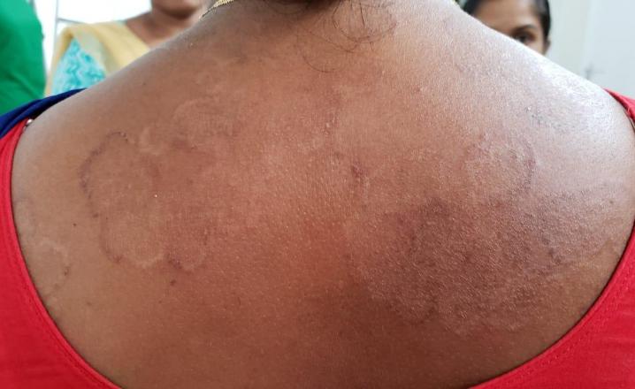 Manhendraganj Skin Disease Spreads To Ampati, Meghalaya